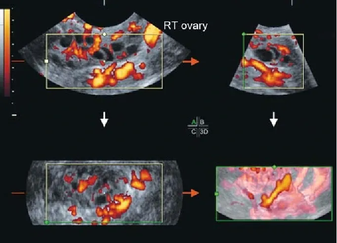 PCOS Detection Using CNN