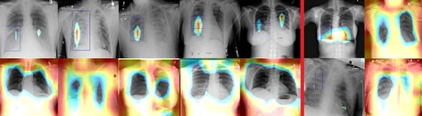 Pneumonia Detection Guide using Machine Learning and Image Processing